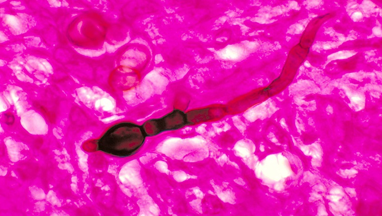 This micrograph shows histopathologic changes that reveal the presence of the fungal agent Blastomyces dermatitidis, 1978. Blastomycosis, caused by Blastomyces dermatitidis, is a flu-like condition with fever, chills, productive cough, myalgia, arthralgia and pleuritic chest pain. There are 1-2 cases per 100,000 people in areas with endemic disease. Image courtesy CDC/Dr. Libero Ajello. (Photo by Smith Collection/Gado/Getty Images).